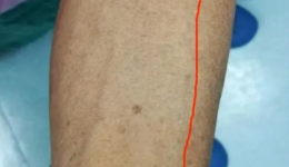 建立血管通路， 延续生命之线--肾内科完成一例桡动脉-贵要静脉转位内瘘手术