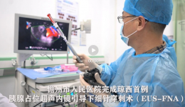 儋州市人民医院开展琼西地区首例超声引导下细针穿刺术（EUS_FNA）