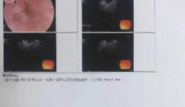 儋州市人民医院消化内科成功完成第一例ESD手术