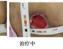 伤口造口治疗图片
